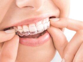 Rubber Band On Braces: Its Benefits & Side Effects