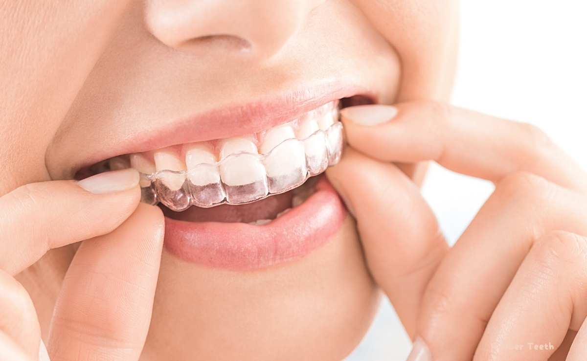 Rubber Band On Braces: Its Benefits & Side Effects